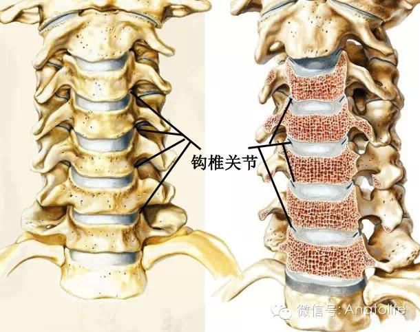 颈椎4～6水平的钩椎关节或luschka关节是骨赘的好发部位.